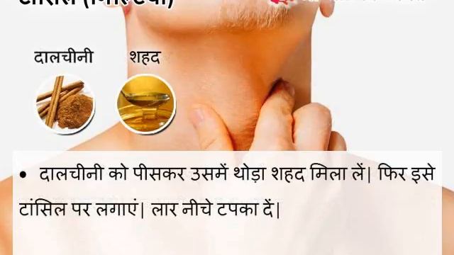 Homemade Remedies for Tonsill (Giltiyam) - टांसिल (गिल्टियां) का घरेलू आयुर्वेदिक उपचार смотреть онлайн