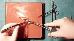 Пластика пахового каналу по Шолдайсу(Shouldice