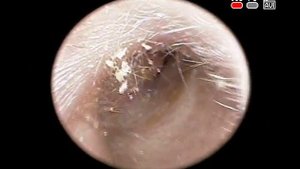 Эндоскопия уха: экзостоз наружного слухового прохода