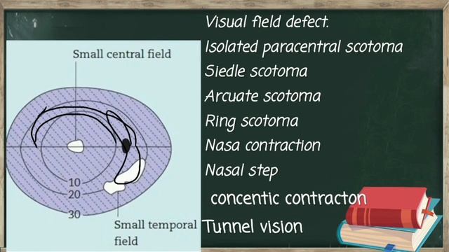 Open angle glaucoma  chronic simple glaucoma
