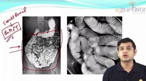 FMGE | Ba. Meal Follow Through | Radiology | Dr. Rajat Jain | DBMCI | eGurukul