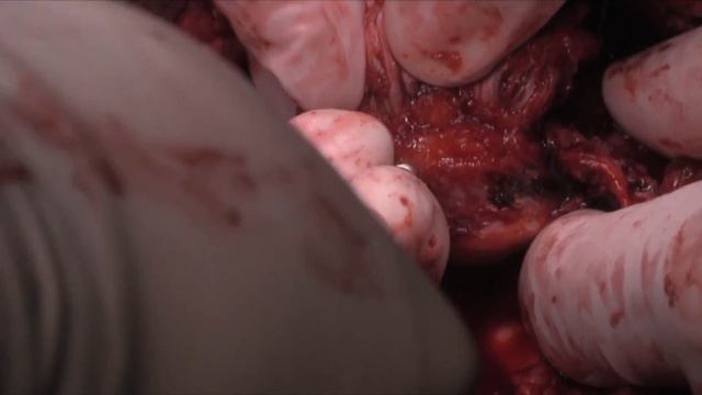 Chronic Patellar Tendon Reconstruction after Failure смотреть онлайн