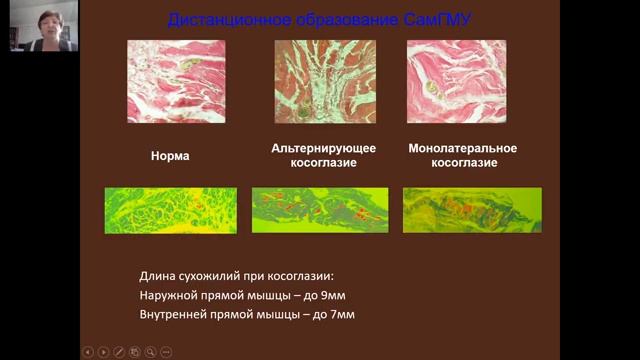 Патология орбиты, косоглазие часть 2