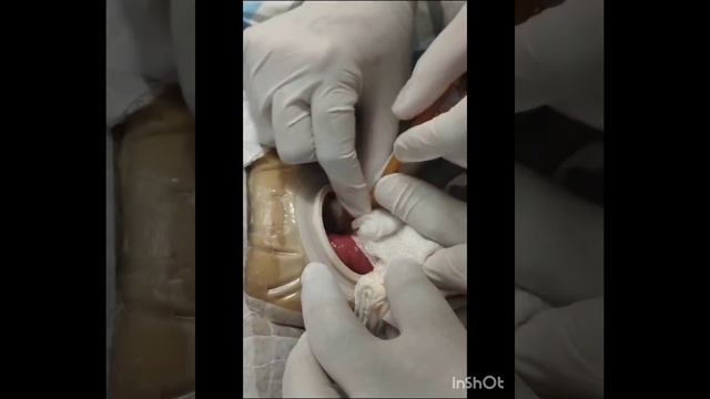 Fleet Enema Through Colostomy | DCMC смотреть онлайн