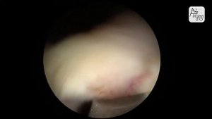 Endoaufnahme Morcellation