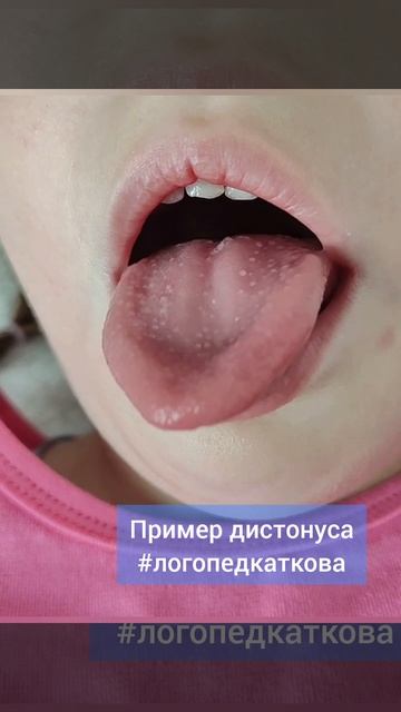 Дистонус. Еще больше про логомассаж на курсах 89269266587
