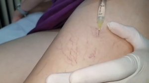 пенная форма склеротерапии склеротерапия вен отзывы склерозирование вен нижних конечностей отзывы
