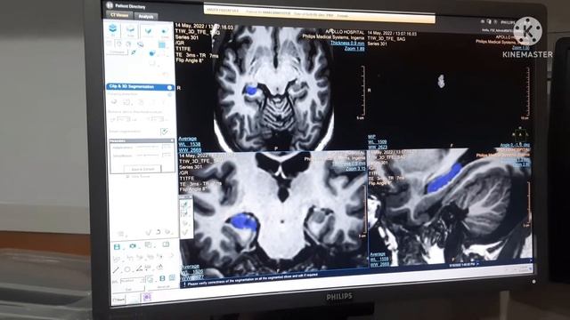 MRI HIPPOCAMPUS VOLUMERTY