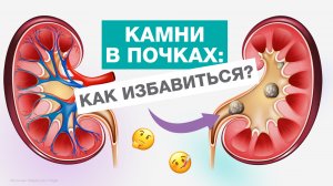 КАК избавиться от КАМНЕЙ В ПОЧКАХ?