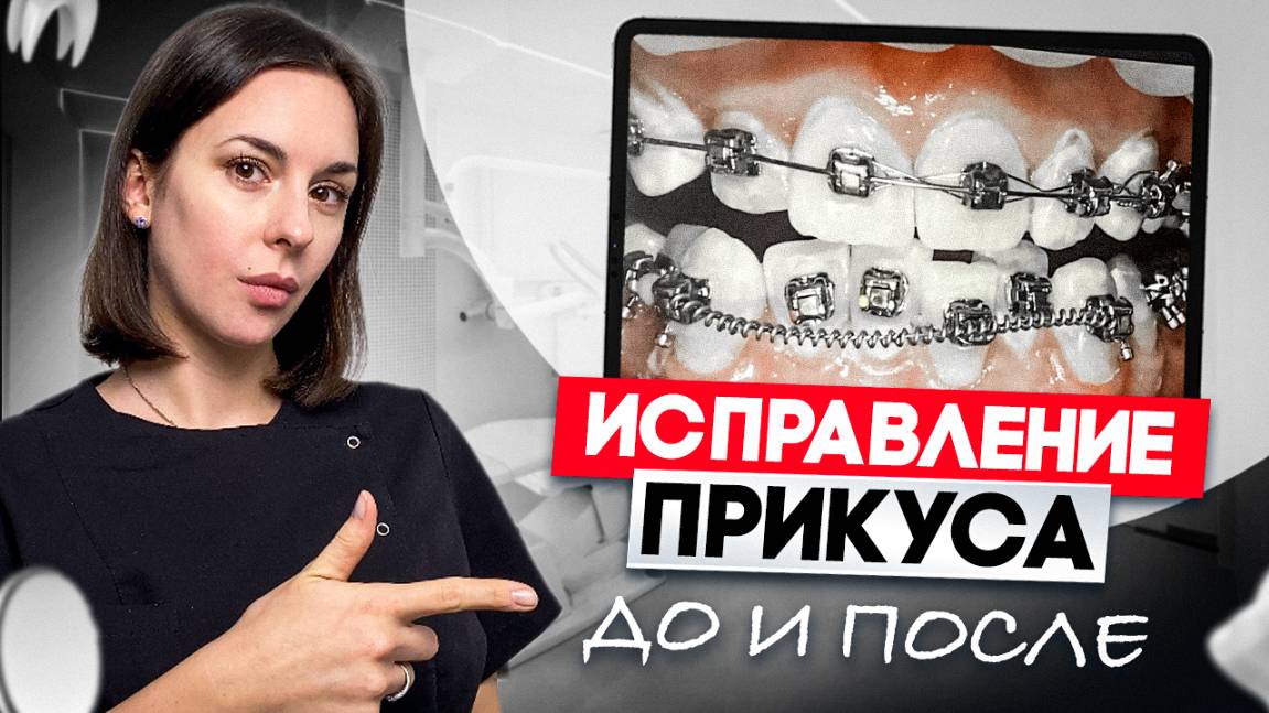 Кривые зубы? 3 пациента которые не поверили своим глазам! Результаты ДО и ПОСЛЕ