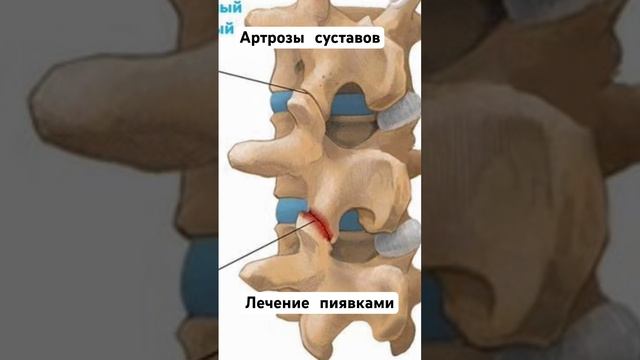 Артроз и лечение суставов пиявками #невролог #гирудотерапия #лечениесуставов #ортопедия