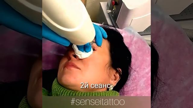 Выведение некачественного татуажа век (стрелок) в Днепре смотреть онлайн