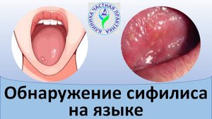 Обнаружение сифилиса на языке