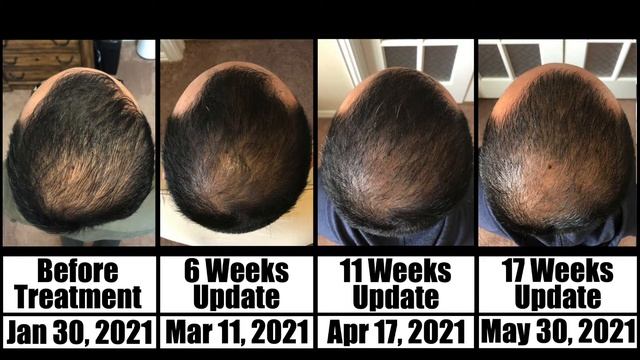 17 Weeks Update - Theradome EVO LH40 Laser Hair Growth смотреть онлайн