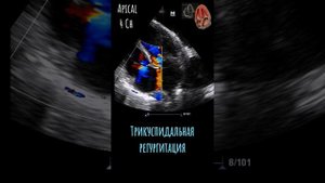 БАКТЕРИАЛЬНЫЙ ЭНДОКАРДИТ. ВЕГЕТАЦИИ НА МИТРАЛЬНОМ И АОРТАЛЬНОМ КЛАПАНАХ #узи #сердце #эхокг