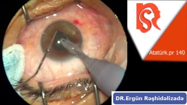 Удаление катаракты через узкий зрачек смотреть онлайн