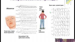 Эпилепсия. Эпилептический статус.
