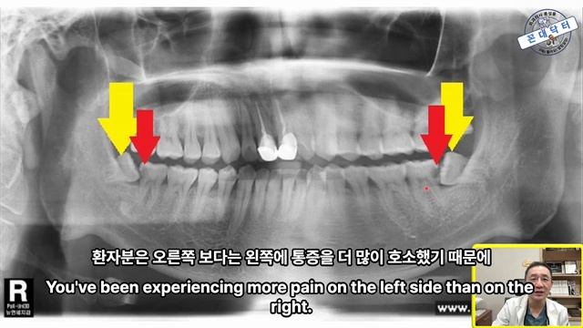 잘못난 사랑니 때문에 앞 치아에 충치가 생겨 극심한 통증을 일으키는 경우 #사랑니발치 #신경치료 #충치치료