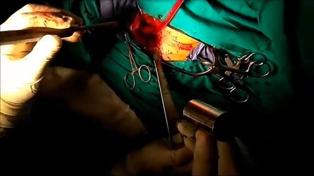 Distal radius corrective osteotomy - смотреть онлайн