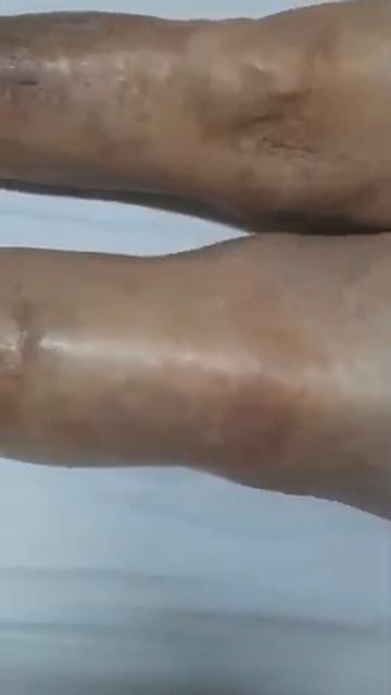 Trombose venosa profunda @medicinainterna3290 смотреть онлайн