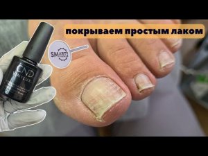 Педикюр с обычным лаком. Подногтевая мозоль. Повреждённые ногти. Смарт педикюр