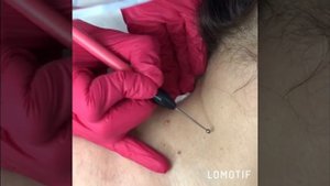 КосмоМедика Удаление папиллом электрокоагулятором