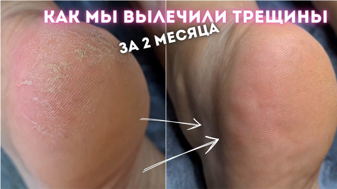 ТРЕЩИНЫ НА ПЯТКАХ результат после одного педикюра. Плёнки для ногтей Kisa.stickers смотреть онлайн