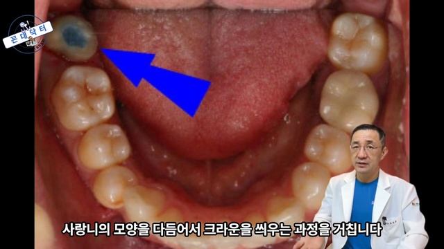 사랑니 자가치아이식 6년 후, 다른 치과에서 뽑고 임플란트 하라던 어금니 신경치료 후 살려낸 6년 후 모습 #치과치료 #치과의사