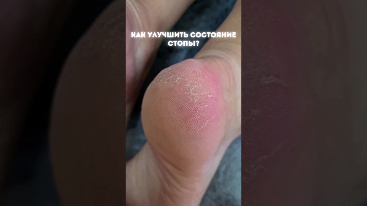 Проблемные стопы, трещины на пятках. Как улучшить состояние стопы? #трещинынапятках #педикюр #ногти смотреть онлайн