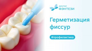 🦷 Герметизация фиссур