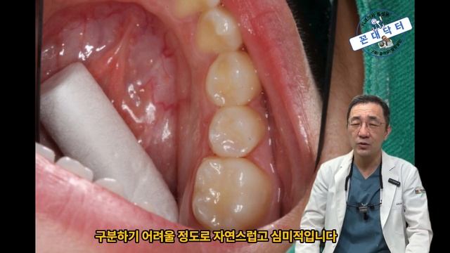 충치치료에 요즘 많이 하는 치아색 인레이의 장점 및 단점 (테세라 인레이)