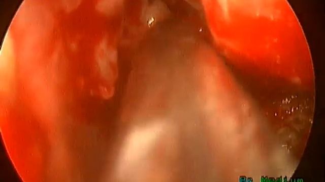 Endoscopic Denker's for Infratemporal fossa clearance in mucormycosis by Dr Ravi Meher смотреть онлайн