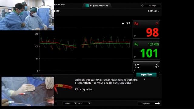 Live MV PCI with RCA CTO & Physiology guided LCX/OM & LAD/D1 Disease Management by Dr.MS Hiremath смотреть онлайн