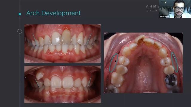 Webinar - Dr Ahmet Yasar - How to sell self ligating braces to your patients  - Aditek Orthodontics
