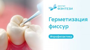 🦷 Герметизация фиссур