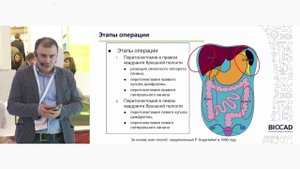 "Роль забрюшинной лимфодиссекции при раке яичника 1-2 стадии"