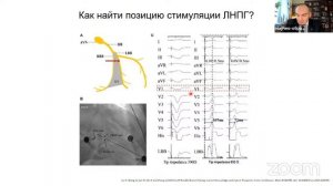 Особенности ЭКГ в 12 отведениях при стимуляции пучка Гиса и области левой ножки пучка Гиса