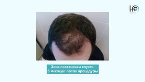 6 месяцев после пересадки волос. Каких результатов ожидать?