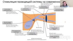 Физиологическая электрокардиостимуляция. Практические нюансы реализации и наблюдения за пациентами
