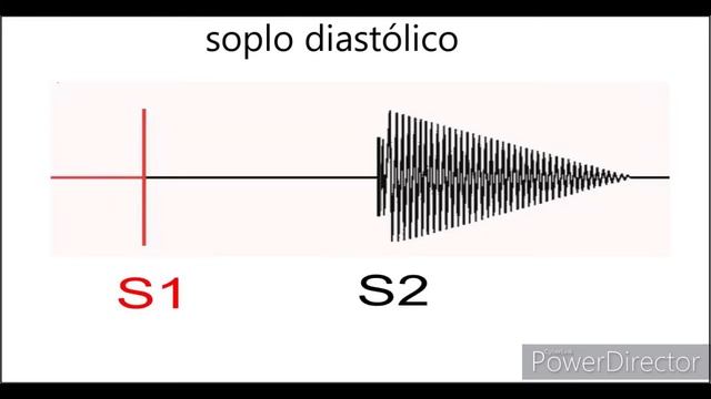 Audio 6-8. Soplo endocarditis mitral.