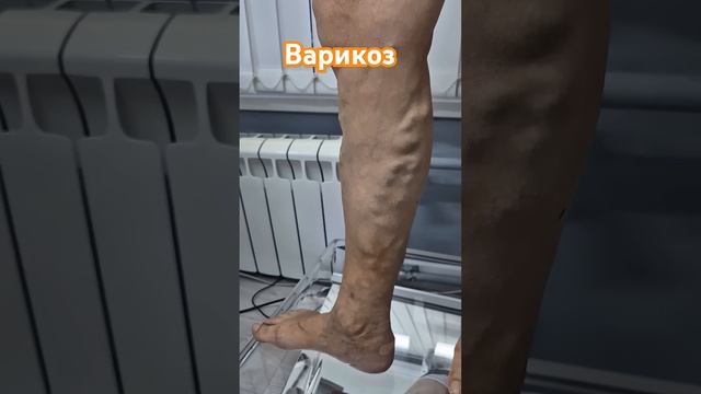 Варикоз может привести к трофической язвы. Флеболог Москва.