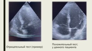 Евгалдаев С.Д. «Bubble»-тест как один из методов диагностики в инсультных отделениях. 30.05.2024.