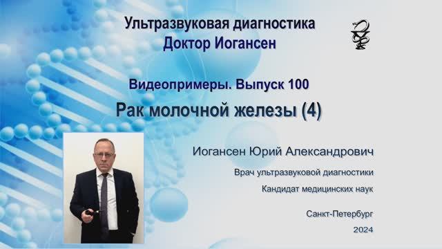 УЗИ. Доктор Иогансен. Видеопримеры. Выпуск 100. Рак молочной железы (4).