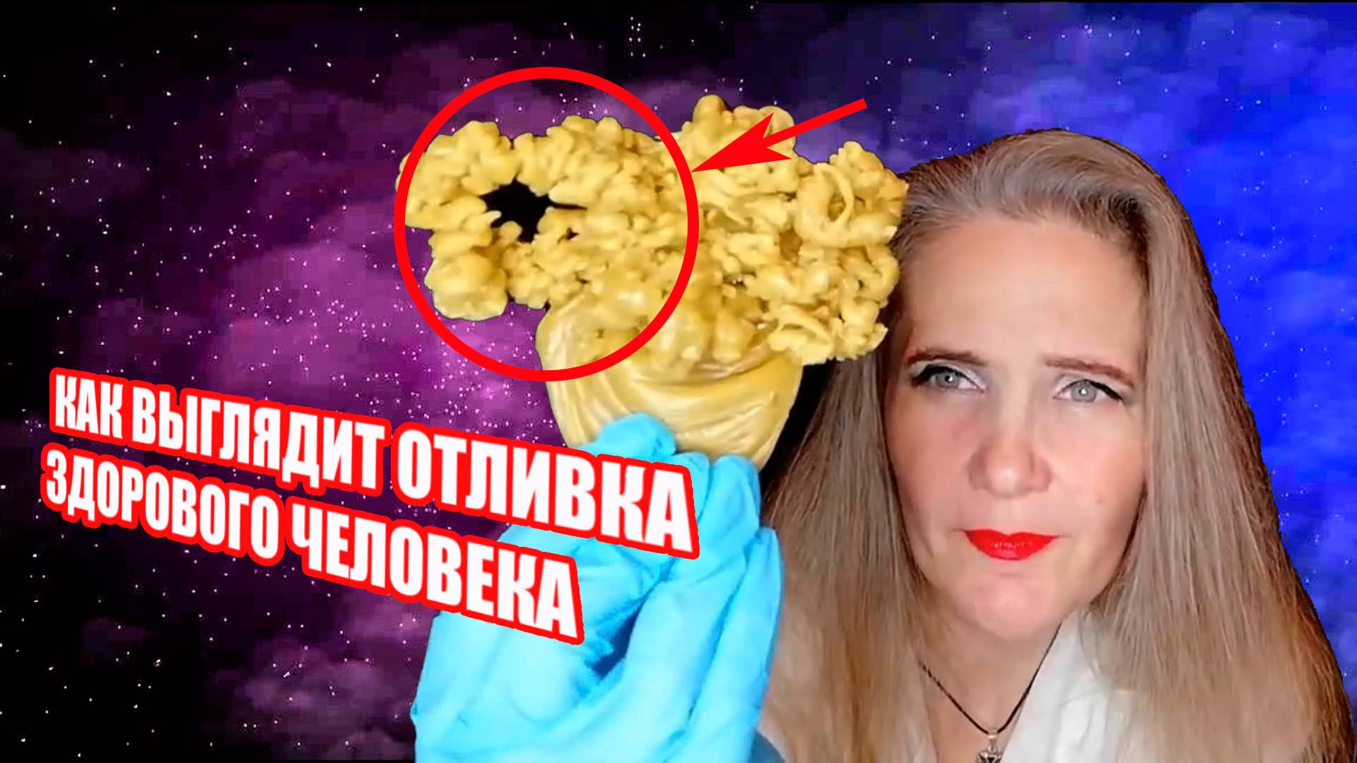 КАК ВЫГЛЯДИТ ОТЛИВКА ЗДОРОВОГО ЧЕЛОВЕКА