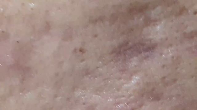 Acne. Jab Gentamicin280mg+Kenalog20mg Doxycycline1bd27 Fluconazole1daily12 Ivermectin10mg смотреть онлайн