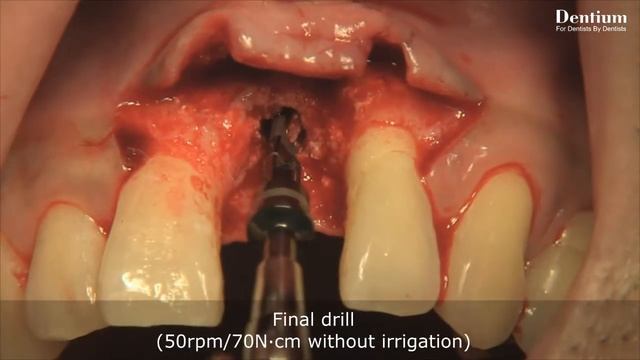 NR Line implantation on Ant. region - staged approach - смотреть онлайн