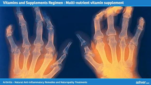 Arthritis - Natural Anti inflammatory Remedies and Naturopathy Treatments
