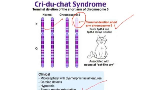 Aneuploidy in Humans-Down syndrome,Patau syndrome