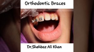 Orthodontic Braces| Dental Braces for upper Diastema case