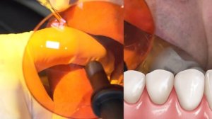 HOW TO  Cement Zirconia Crown for Less Retentive Tooth Prep